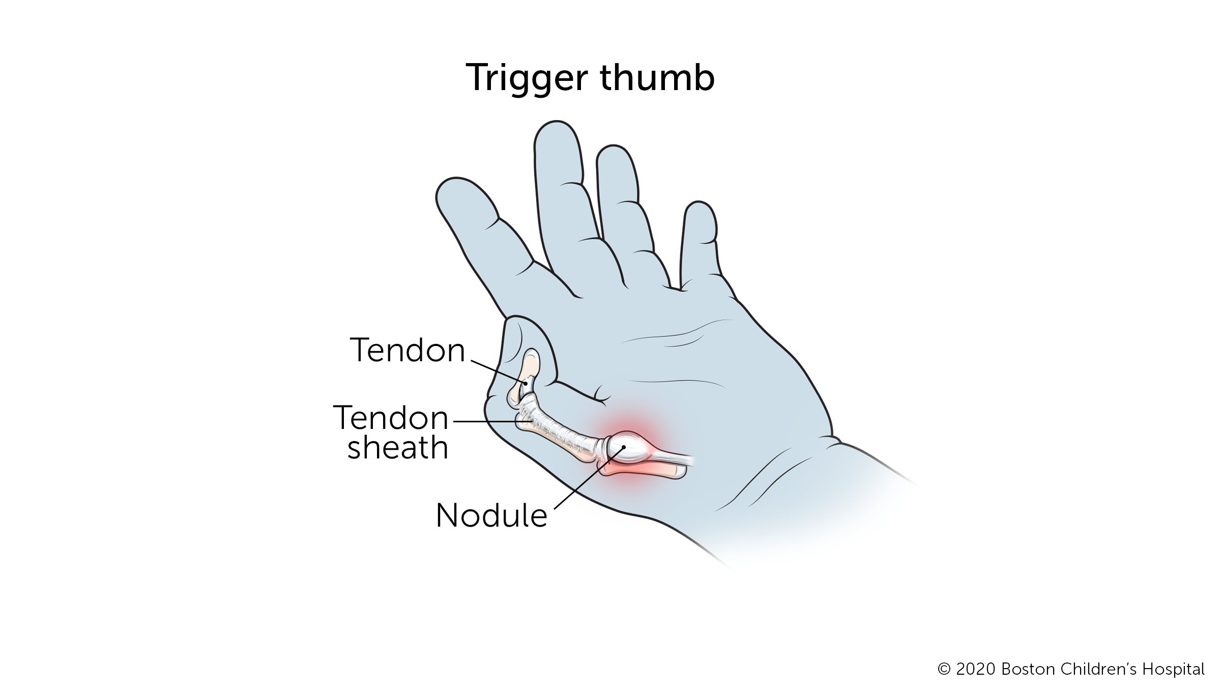 Trigger Finger Causes Symptoms Treatment Advanced Sur