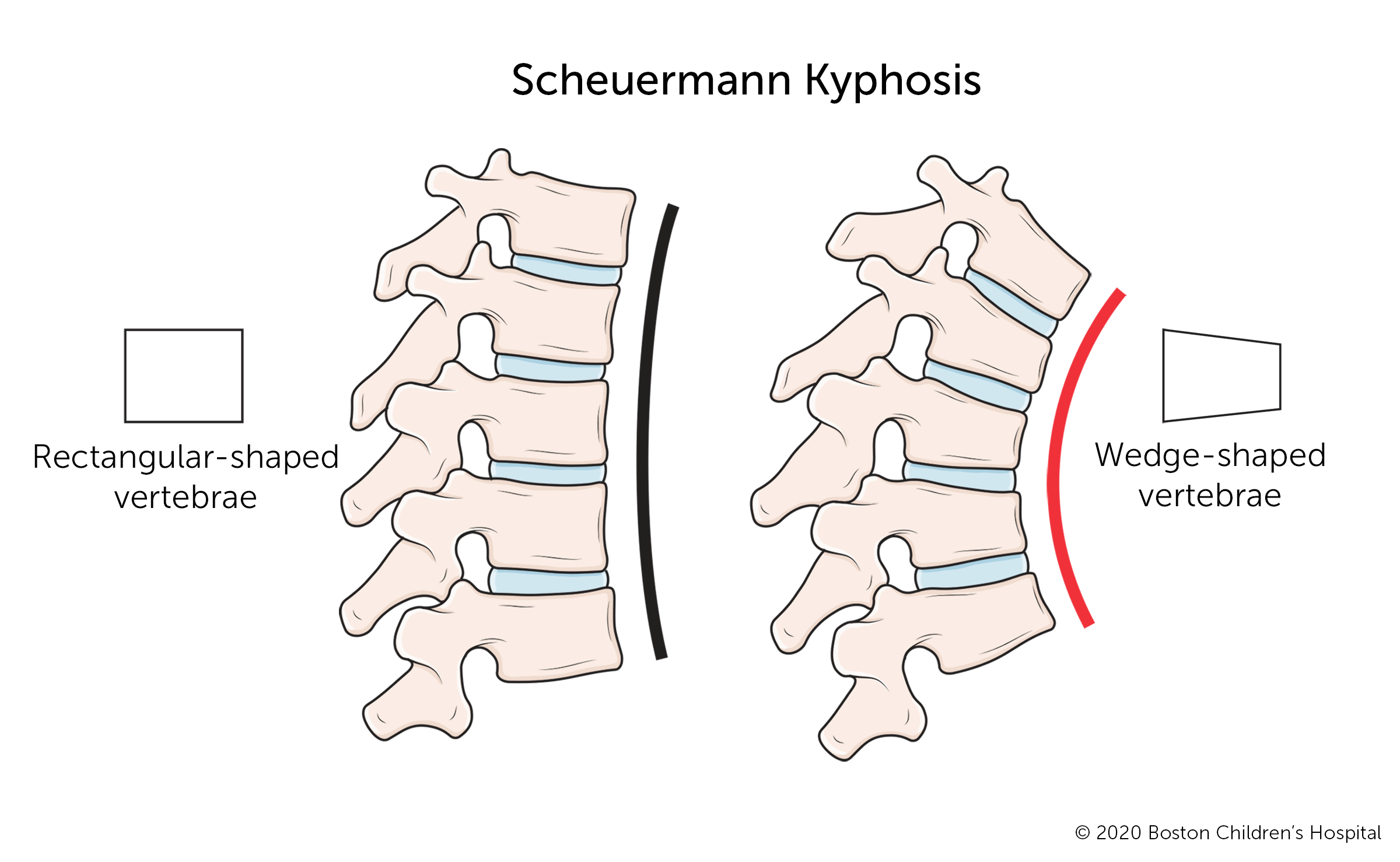cervical kyphosis in child        <h3 class=