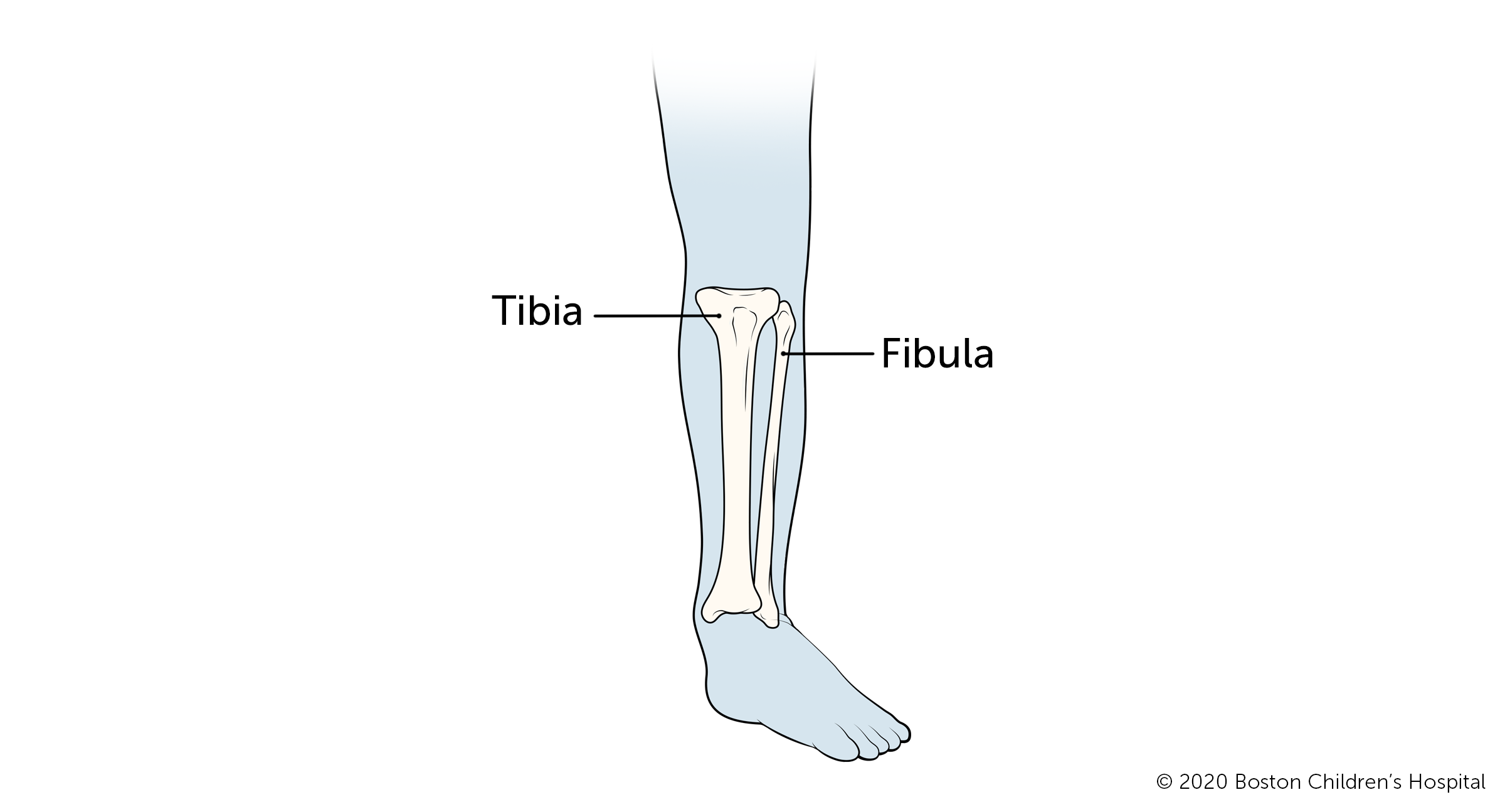 Broken Tibia-Fibula (Shinbone/Calf Bone) | Boston Children's Hospital